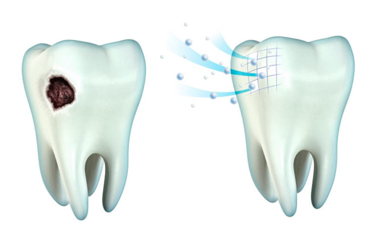 Что делать, если разрушается зуб?