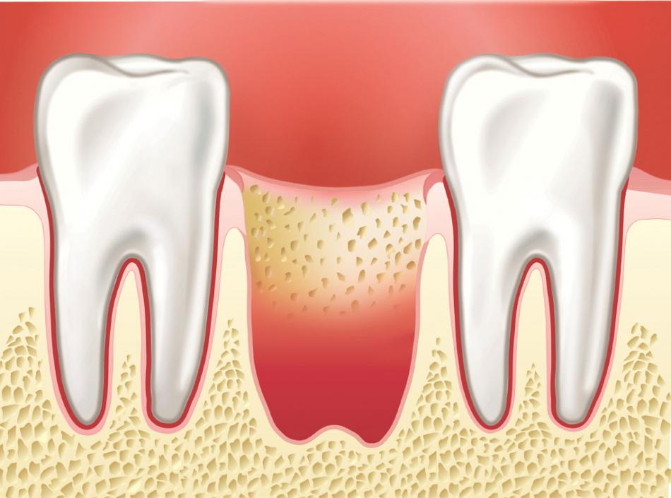 Альвеолит - сухая лунка после удаления зуба.