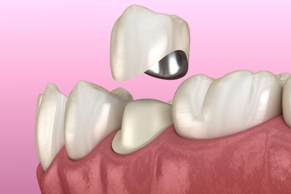 Чем снять боль зуба под коронкой?