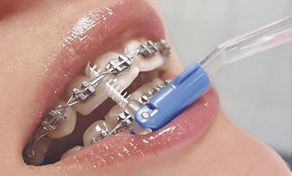 Чиста зубов с брекет-системой в домашних условиях.