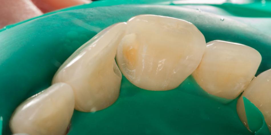 Как лечат межзубный кариес передних и жевательных зубов?
