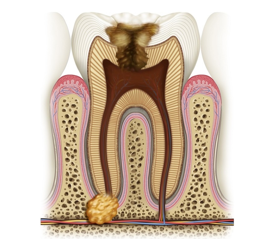 Киста под зубом: симптомы и лечение.