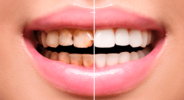 Эстетическое восстановление эмали зубов.