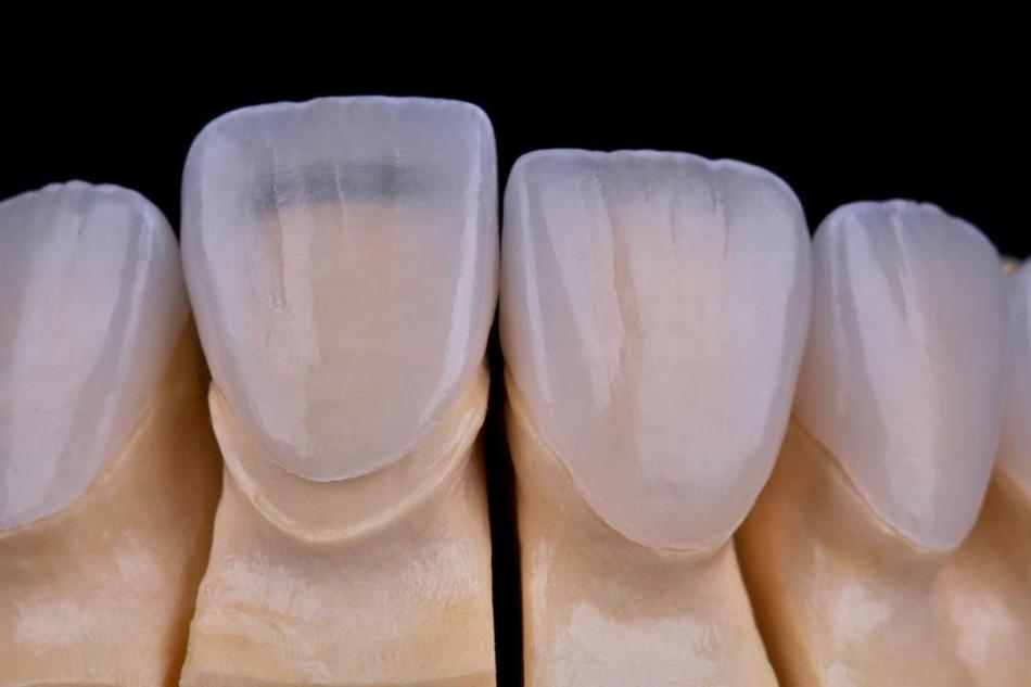 Установка ламинатов на зубы в стоматологии.